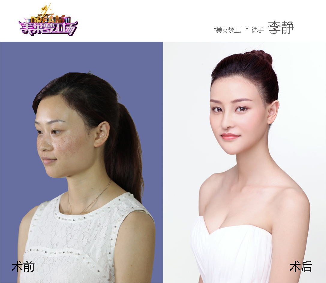 "胸险"解除!领世丰胸技艺美莱见